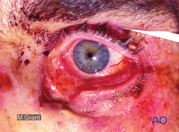 Inferior canalicular disruption with a significant avulsive soft-tissue injury to the lower eyelid and upper cheek.