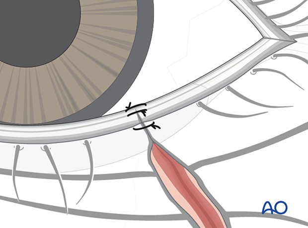 Repair of periorbital soft-tissue injuries and lacrimal system in NOE injuries – partial thickness