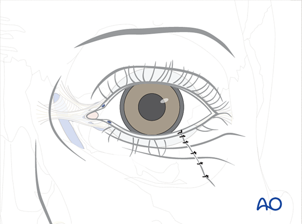 Repair of periorbital soft-tissue injuries and lacrimal system in NOE injuries – partial thickness