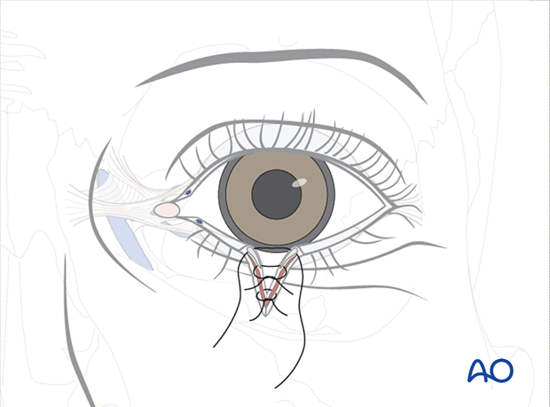 Repair of periorbital soft-tissue injuries and lacrimal system in NOE injuries – full thickness (without canalicular involvement)