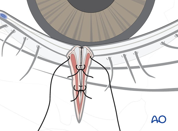 Repair of periorbital soft-tissue injuries and lacrimal system in NOE injuries – full thickness (without canalicular involvement)
