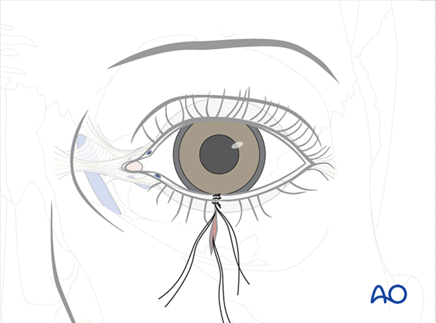 Repair of periorbital soft-tissue injuries and lacrimal system in NOE injuries – full thickness (without canalicular involvement)