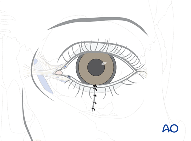 Repair of periorbital soft-tissue injuries and lacrimal system in NOE injuries – full thickness (without canalicular involvement)