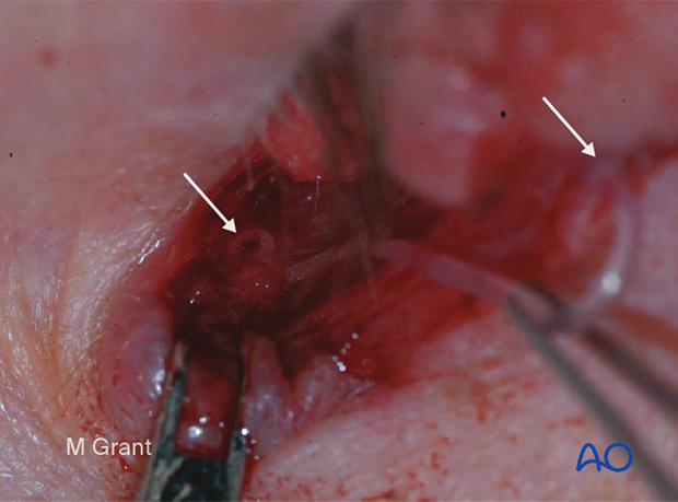 Repair of periorbital soft-tissue injuries and lacrimal system in NOE injuries – full thickness (monocanalicular intubation)