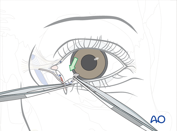 Repair of periorbital soft-tissue injuries and lacrimal system in NOE injuries – full thickness (monocanalicular intubation)