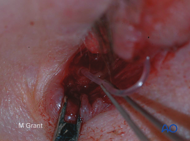 Repair of periorbital soft-tissue injuries and lacrimal system in NOE injuries – full thickness (monocanalicular intubation)