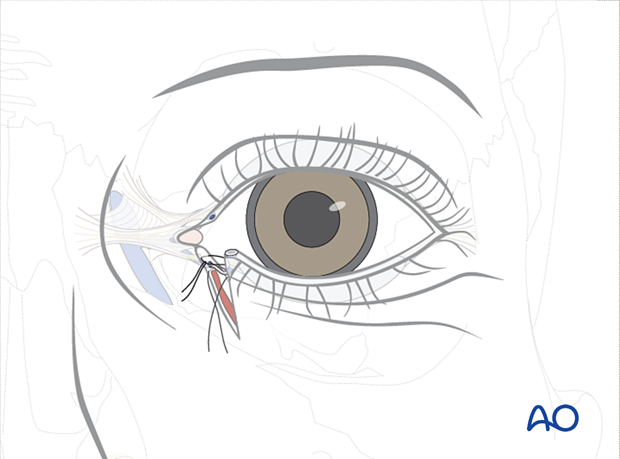 Repair of periorbital soft-tissue injuries and lacrimal system in NOE injuries – full thickness (monocanalicular intubation)