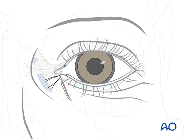 Repair of periorbital soft-tissue injuries and lacrimal system in NOE injuries – full thickness (monocanalicular intubation)