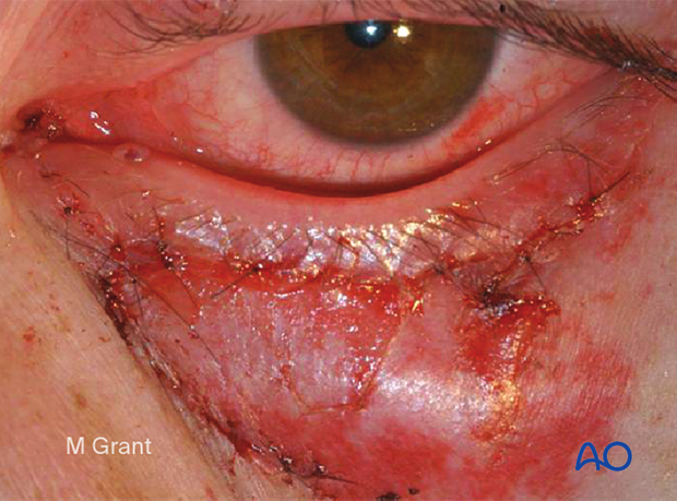 Repair of periorbital soft-tissue injuries and lacrimal system in NOE injuries – full thickness (monocanalicular intubation)