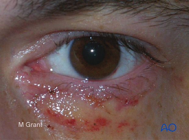 Repair of periorbital soft-tissue injuries and lacrimal system in NOE injuries - aftercare