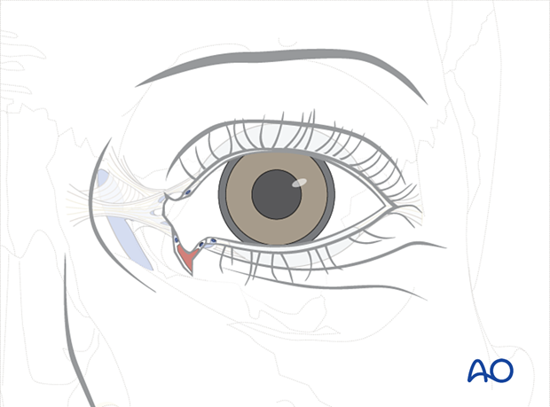 Repair of periorbital soft-tissue injuries and lacrimal system in NOE injuries - full-thickness (bicanalicular intubation)