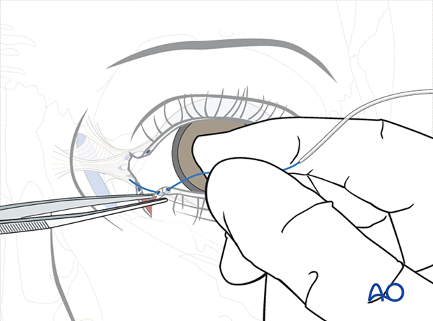 Repair of periorbital soft-tissue injuries and lacrimal system in NOE injuries - full-thickness (bicanalicular intubation)