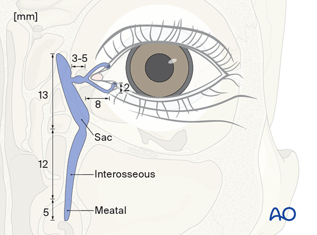 Repair of periorbital soft-tissue injuries and lacrimal system in NOE injuries - full-thickness (bicanalicular intubation)
