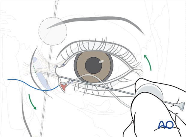 Repair of periorbital soft-tissue injuries and lacrimal system in NOE injuries - full-thickness (bicanalicular intubation)