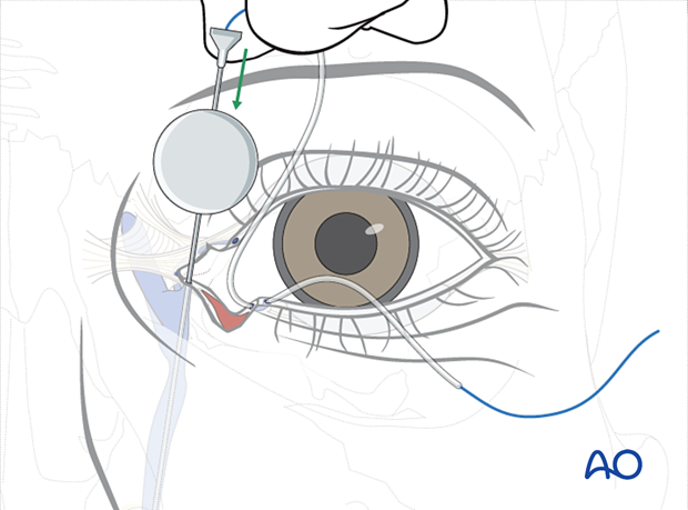 Repair of periorbital soft-tissue injuries and lacrimal system in NOE injuries - full-thickness (bicanalicular intubation)