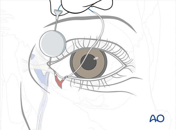 Repair of periorbital soft-tissue injuries and lacrimal system in NOE injuries - full-thickness (bicanalicular intubation)