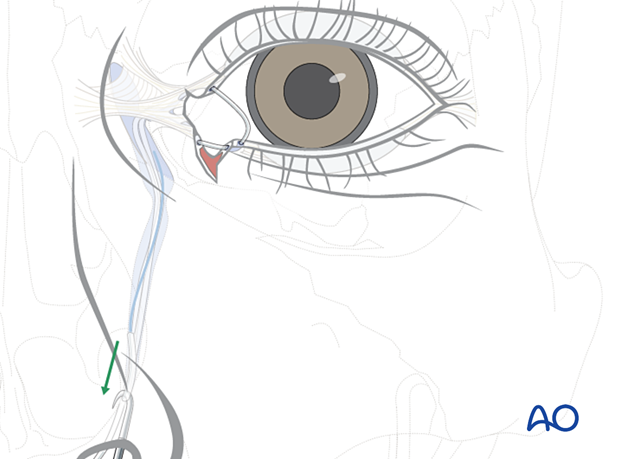 Repair of periorbital soft-tissue injuries and lacrimal system in NOE injuries - full-thickness (bicanalicular intubation)
