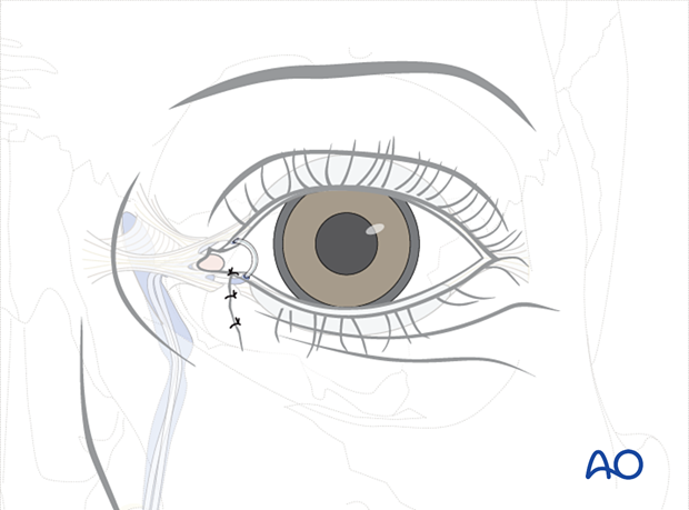 Repair of periorbital soft-tissue injuries and lacrimal system in NOE injuries - full-thickness (bicanalicular intubation)