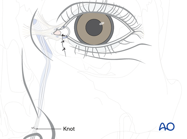 Repair of periorbital soft-tissue injuries and lacrimal system in NOE injuries - full-thickness (bicanalicular intubation)