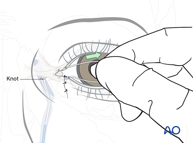 Repair of periorbital soft-tissue injuries and lacrimal system in NOE injuries - full-thickness (bicanalicular intubation)