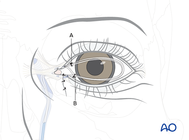 Repair of periorbital soft-tissue injuries and lacrimal system in NOE injuries - full-thickness (bicanalicular intubation)
