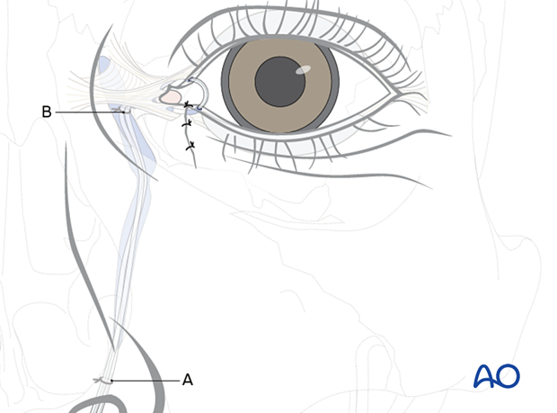 Repair of periorbital soft-tissue injuries and lacrimal system in NOE injuries - full-thickness (bicanalicular intubation)