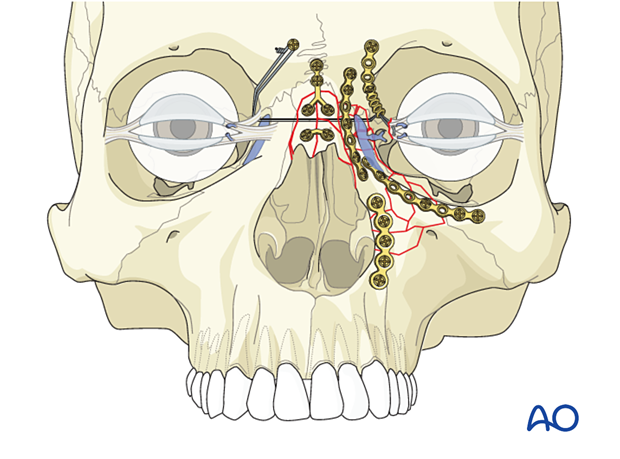 Involvement of the lacrimal system in NOE fractures 