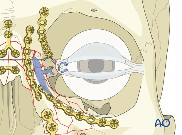 Involvement of the lacrimal system in NOE fractures 