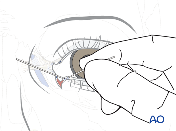 Involvement of the lacrimal system in NOE fractures 
