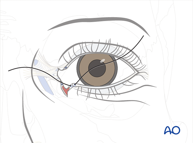 Involvement of the lacrimal system in NOE fractures 
