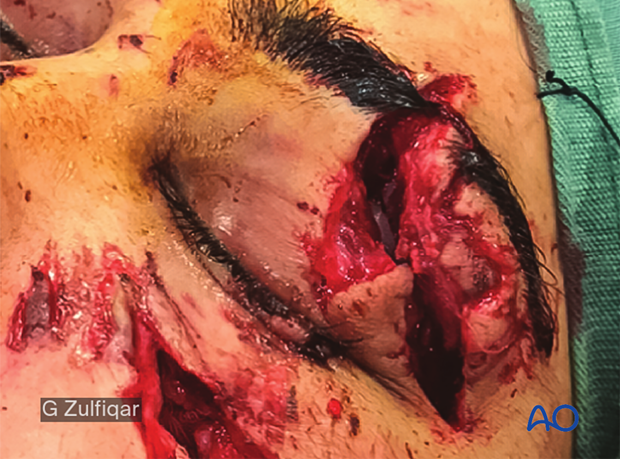  Repair of periorbital soft-tissue injuries and lacrimal system in NOE injuries – case example
