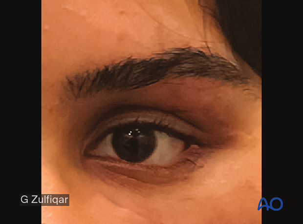 Repair of periorbital soft-tissue injuries and lacrimal system in NOE injuries – case example
