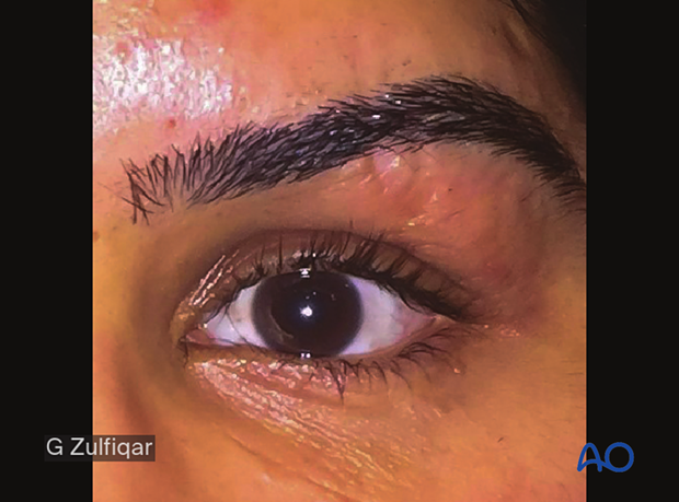 Repair of periorbital soft-tissue injuries and lacrimal system in NOE injuries – case example