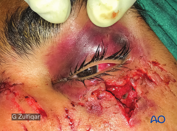 Repair of periorbital soft-tissue injuries and lacrimal system in NOE injuries – case example