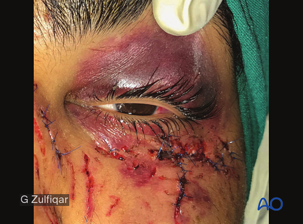 Repair of periorbital soft-tissue injuries and lacrimal system in NOE injuries – case example