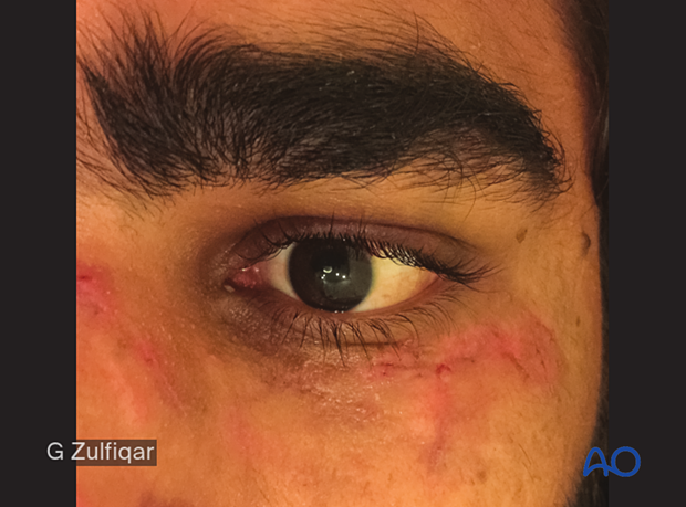 Repair of periorbital soft-tissue injuries and lacrimal system in NOE injuries – case example