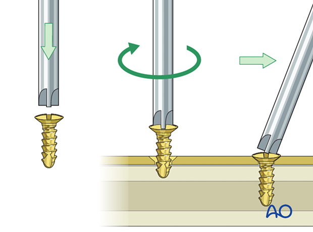 choice of implants - types of screw drivers