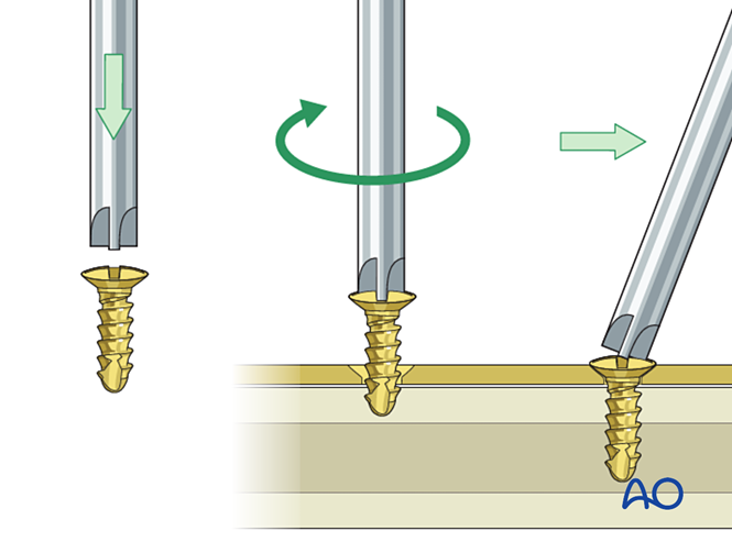 Choice of implants