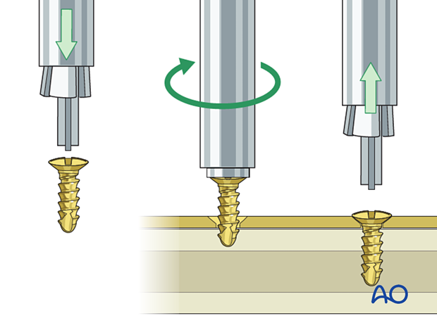 choice of implants - screwdrivers with holding sleeves