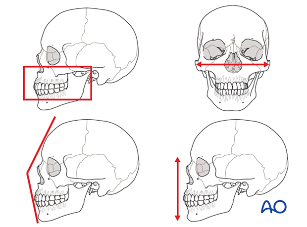 Midfacial injuries – surgical principles
