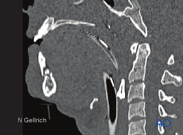 Examination of patients with midfacial injuries