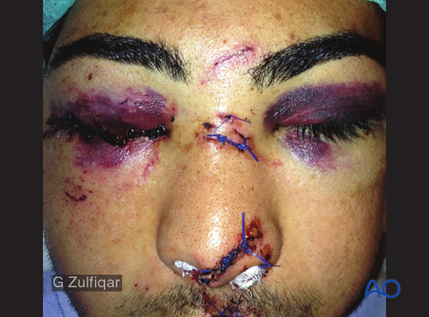 -25400000Examination of patients with midfacial injuries - patient has a bilateral peri-orbital hematoma indicating bilateral orbital fractures