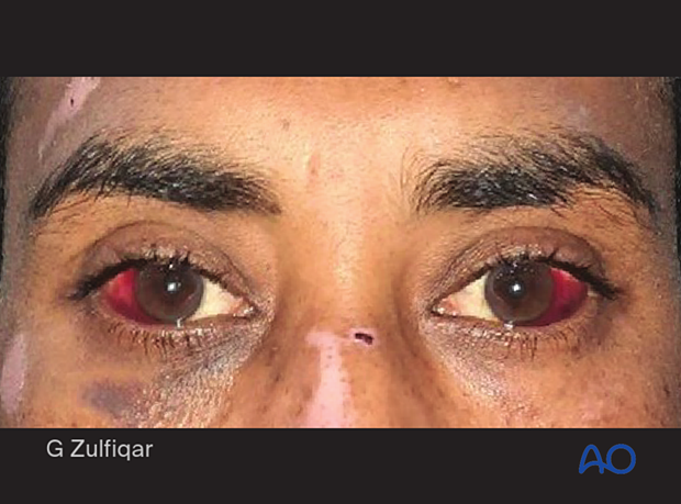 Examination of patients with midfacial injuries - subconjunctival bleeding (hyposphagma)