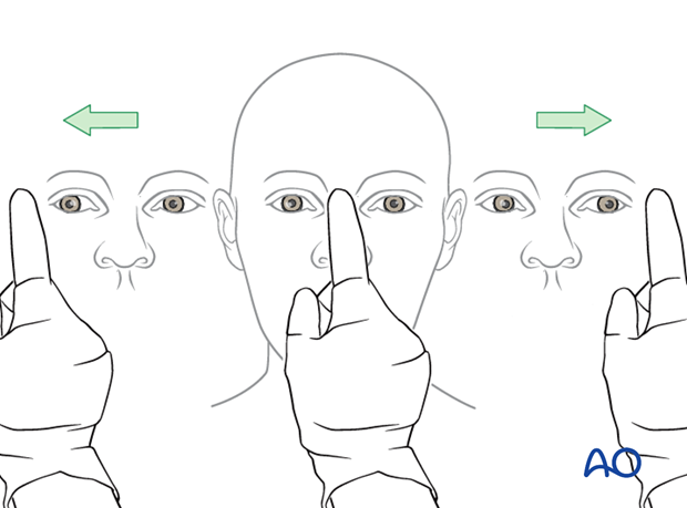 examination of patients with midfacial injuries - ocular motility testing