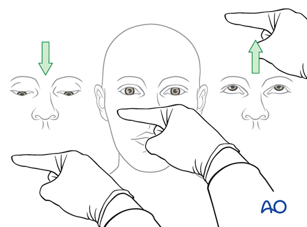 examination of patients with midfacial injuries - checking that the extraocular muscles (EOM) are functioning properly