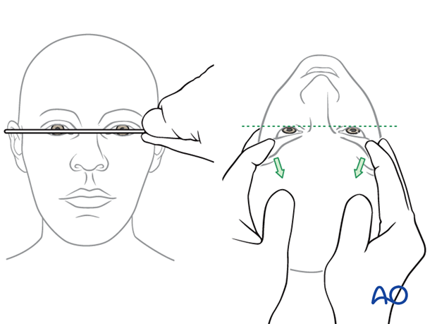 examination of patients with midfacial injuries - globe position