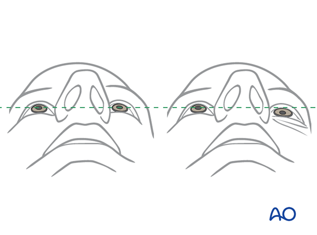 examination of patients with midfacial injuries - globe position