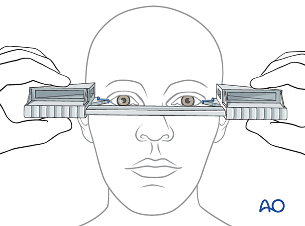 examination of patients with midfacial injuries - Hertel exophthalmometer
