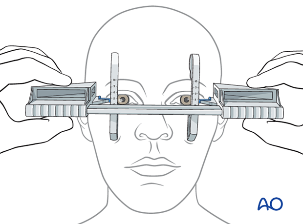 examination of patients with midfacial injuries - Naugle exophthalmometer