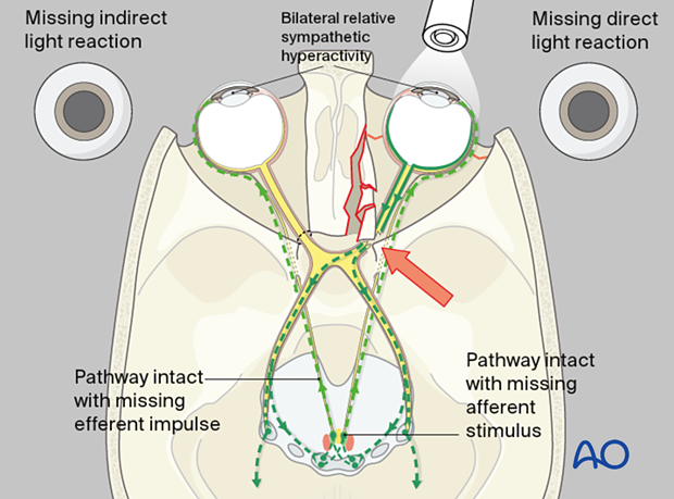 examination of patients with midfacial injuries - Relative afferent pupillary defect (RAPD)